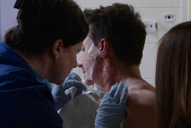 Leeds nurse Paul Blakemore worked with the makeup team as they created Ryan's acid burns (Photo: ITV)