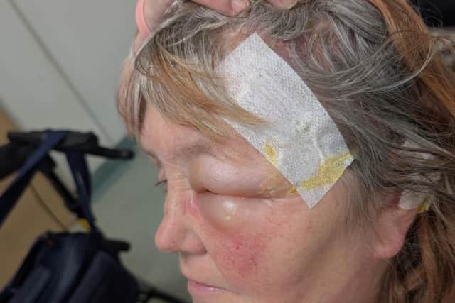 Susan's burns after the kettle attack