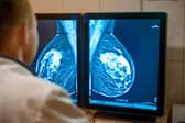 Around 9 in 10 of breast cancers diagnosed through screening are found at an early stage.