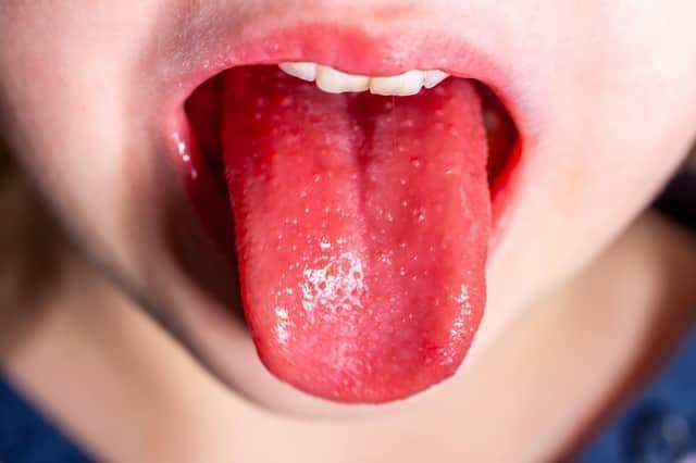 A child suffering from scarlet fever.