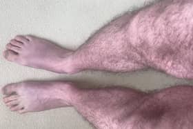If your legs start turning blue after standing up for just a few minutes it could be Long Covid, warns a new study (Photo: University of Leeds)