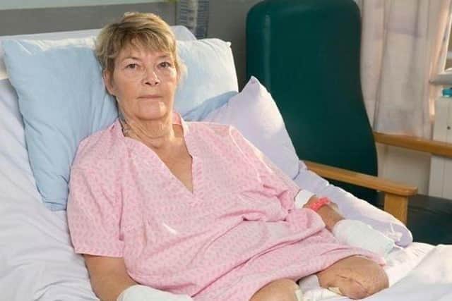 Kim's legs and hands had to be amputated after sepsis