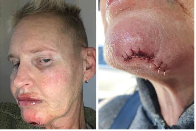 Lorna Lee Thynne had to receive stitches following the attack near her home in Horsforth.