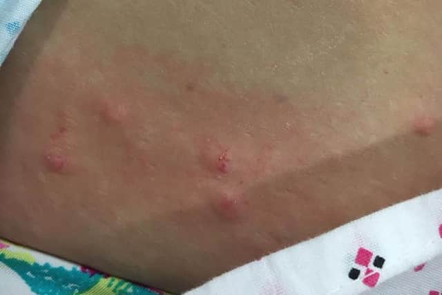 Bedbugs aren't dangerous and don't spread any diseases, but some people experience a reaction to their bites.
