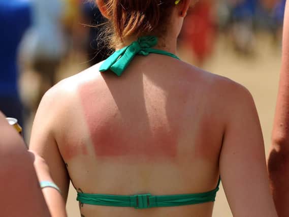 After a weekend in the sun many people will be feeling sore and sunburned today