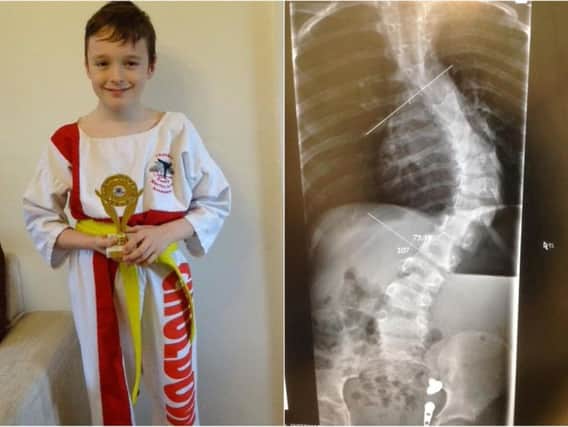 Connor Demetriou, 10, has started karate after pioneering surgery.