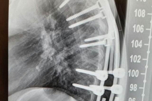 Connor's spine after the surgery.