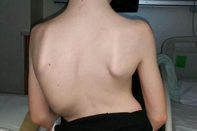 Connor's spine before surgery.