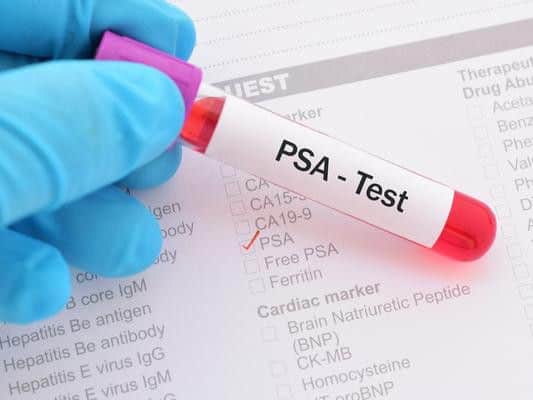 NHS England said the test marks an exciting and promising step forward for a national screening programme for prostate cancer