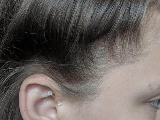 Bobbie May Smith's clear plastic daith piercing, which was done to relieve pain from migraines.