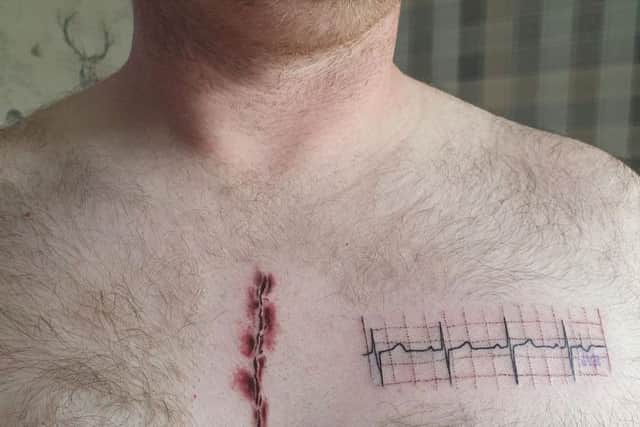 Martin Watts has had his son Joey's heart surgery scar tattooed on his chest.