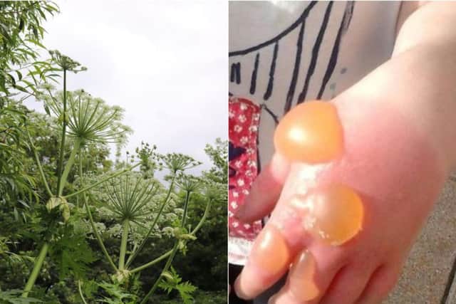 Coming into contact with Giant Hogweed can cause painful blisters (Photo: Incredible Edible / SWNS).