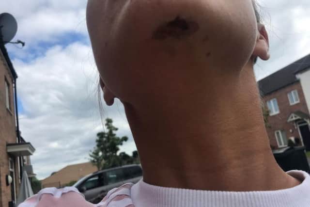 Bruising left on the woman's chin after landing on her face in the incident