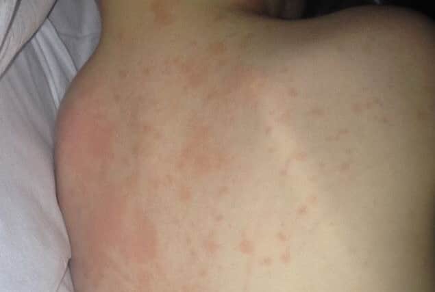 The Kawasaki disease rash on Ryan Tomson.