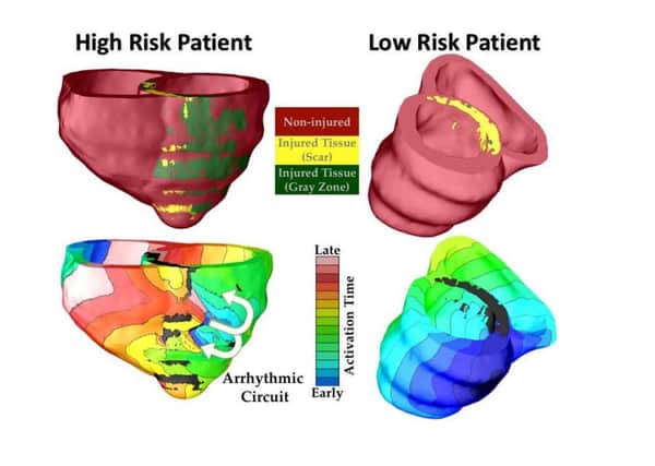 Virtual-heart arrhythmia risk prediction for two patients with previous injury, one classified as high risk, and the other as low risk. In the high risk heart, arrhythmia developed, indicated by the electrical wave that was Ã¢Â¬SstuckÃ¢Â¬Â rotating around the injury. In the low risk heart, despite the presence of injury, arrhythmia was not formed, with the electrical wave propagating uniformly. Credit: Hermenegild Arevalo and Natalia Trayanova. See National story NNHEART; Personalised 3D computer models of patients' hearts have been created to help cardiologists carry out life saving treatments. The virtual organs, for instance, can work out a heart attack victims' risk of developing a potentially fatal irregular beat. They can then be surgically implanted with a defibrillator, a device that applies electric shocks to the heart when its rhythm goes out of kilter. Arrhythmias or heart rhythm problems are experienced by more than two million people a year in the UK.