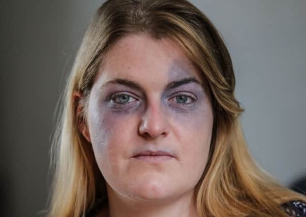Adele Uden, 26, of Mansfield, Notts, who is suffering from mysterious facial bruising which has doctors stumped. January 4, 2017.  A bride-to-be is battling a mystery illness which led to fears she was a victim of domestic abuse - because her face is constantly covered in BRUISES.  See NTI story NTIBRUISES.  Adele Uden, 26, has been forced to leap to the defence of her partner after the ultra-rare condition led to false rumours she was being beaten at home.  She first began to suffer from problems 18 months after her seven-year-old son Zak was born via emergency caesarean section.  The mum-of-one was left in agonising pain and needed surgery after the procedure, which caused scar tissue.  She was later diagnosed with polycystic ovary syndrome and endometriosis, where tissue that behaves like the lining of the womb is found outside the womb.  Adele also suffers from unexplained bruising which has led to vicious rumours that her fiance Chris North, 26, had been beating her.  She has also faced cruel taunts in t