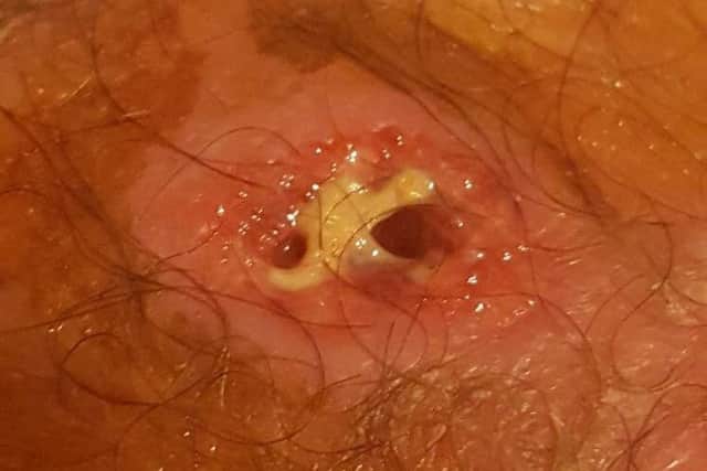 Grim: The false black widow spider bite. Photo: SWNS