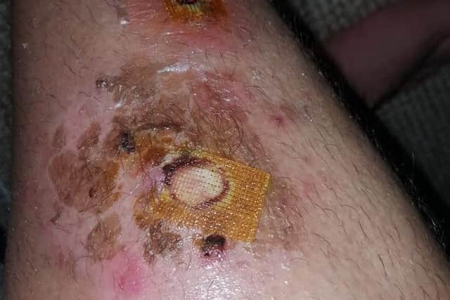 Grim: The false black widow spider bite. Photo: SWNS