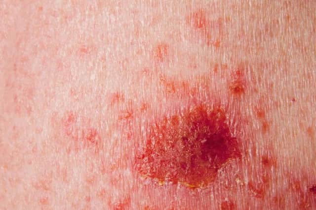 Drinking just one glass of beer or wine a day could give you skin cancer, scientists have warned - and it isn't to do with spending time in pub beer gardens.