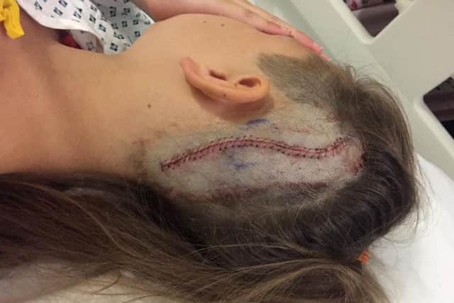 Picture of 10-year-old Lola Daley after she underwent an eight hour operation to have a brain tumour the size of a ping pong ball removed. Picture: The Sick Children's Trust/PA Wire