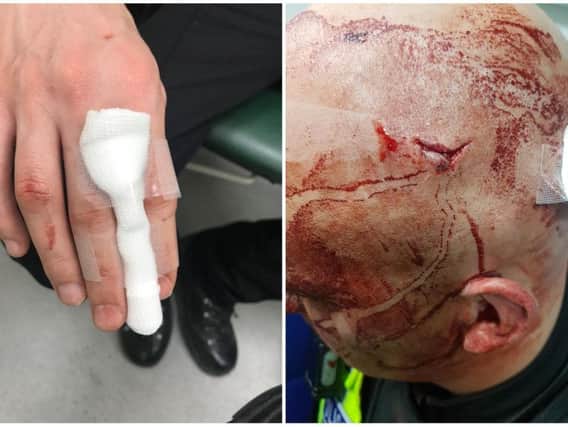 Some of the injuries sustained by police officers in Leeds and Bradford last night.