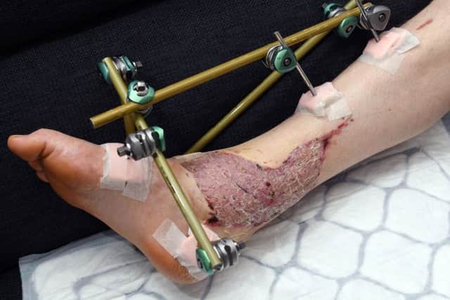 The metal frame holding the bones in Stuart Sunderland's leg and ankle in place.