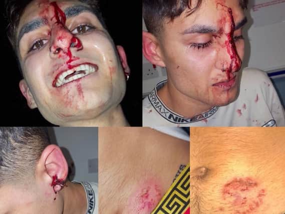 Photos of Mitt Malhotra's injuries